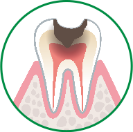 虫歯と口内フローラ